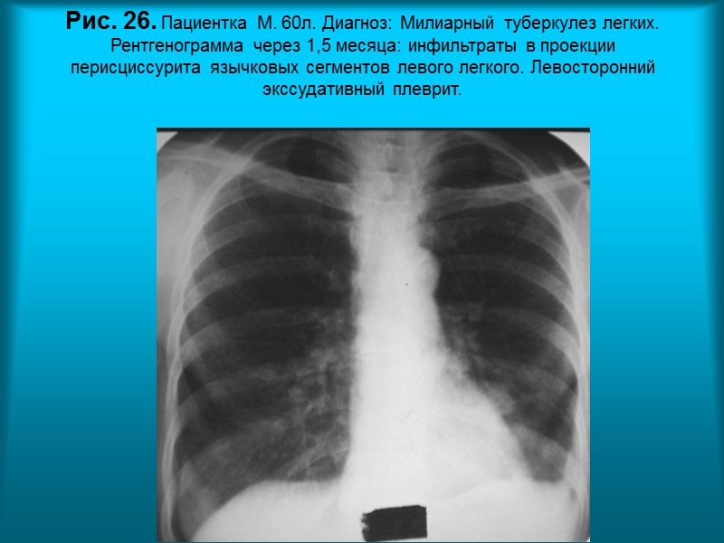 Н.С. Воротынцева. С.С. Гольев  Рентгенопульмонология Рис. 22.  Пациентка В. 40 л. Диагноз: