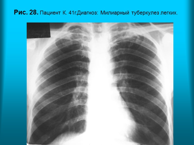 Н.С. Воротынцева. С.С. Гольев  Рентгенопульмонология Рис. 23. Пациентка Б. 39л. Диагноз: Диссеминированный туберкулез