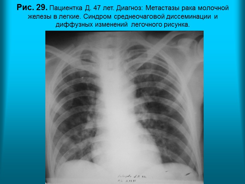 Н.С. Воротынцева. С.С. Гольев  Рентгенопульмонология Рис. 24. Пациент С. 74г. Диагноз: Цирроз верхней
