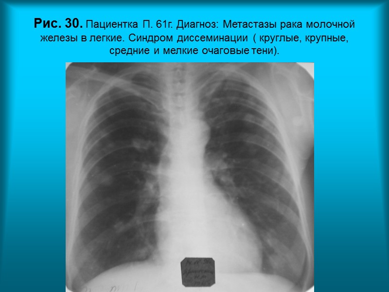 Н.С. Воротынцева. С.С. Гольев  Рентгенопульмонология Рис.25. Пациентка М. 60л. Диагноз: Милиарный туберкулез легких