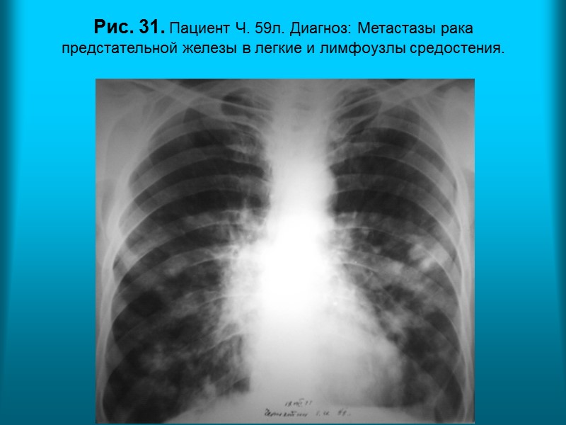 Н.С. Воротынцева. С.С. Гольев  Рентгенопульмонология Рис. 26. Пациентка М. 60л. Диагноз: Милиарный туберкулез