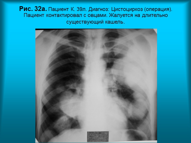 Н.С. Воротынцева. С.С. Гольев  Рентгенопульмонология Рис. 27.  Пациент М. 33г. Диагноз: Туберкулезный