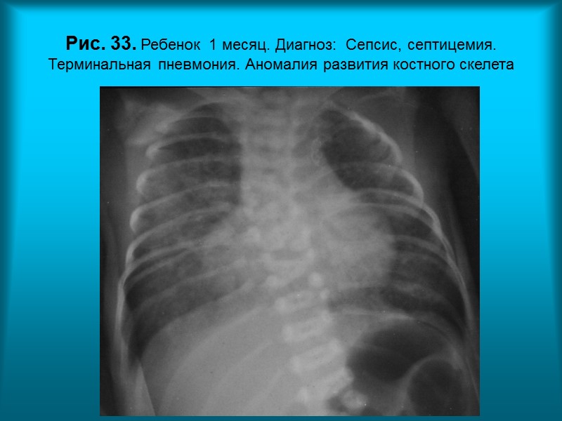 Н.С. Воротынцева. С.С. Гольев  Рентгенопульмонология Рис. 30. Пациентка П. 61г. Диагноз: Метастазы рака