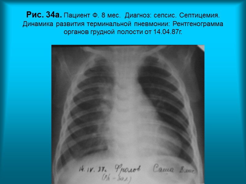 Н.С. Воротынцева. С.С. Гольев  Рентгенопульмонология Рис. 31. Пациент Ч. 59л. Диагноз: Метастазы рака