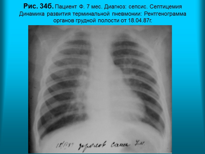 Н.С. Воротынцева. С.С. Гольев  Рентгенопульмонология Рис. 32а. Пациент К. 39л. Диагноз: Цистоциркоз (операция).