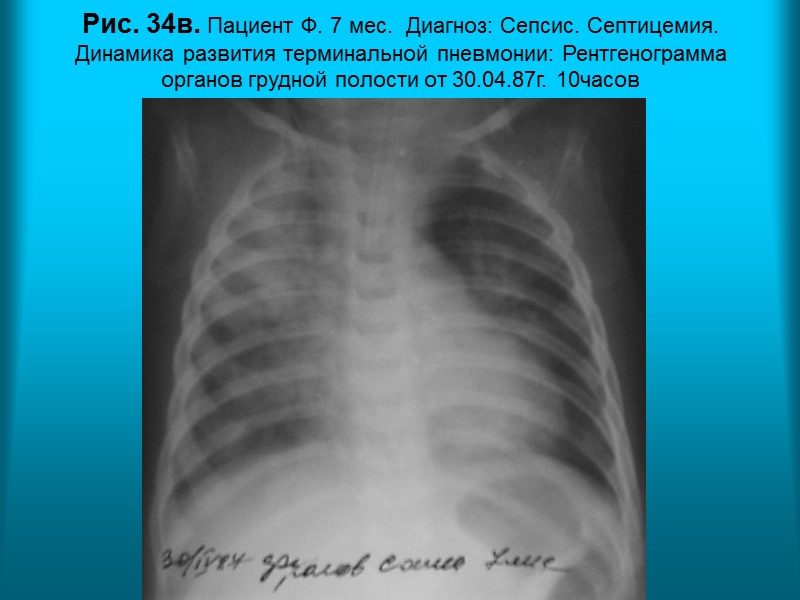 Н.С. Воротынцева. С.С. Гольев  Рентгенопульмонология Рис. 32б. Пациент К. 39л. Диагноз: Цистоциркоз (операция).