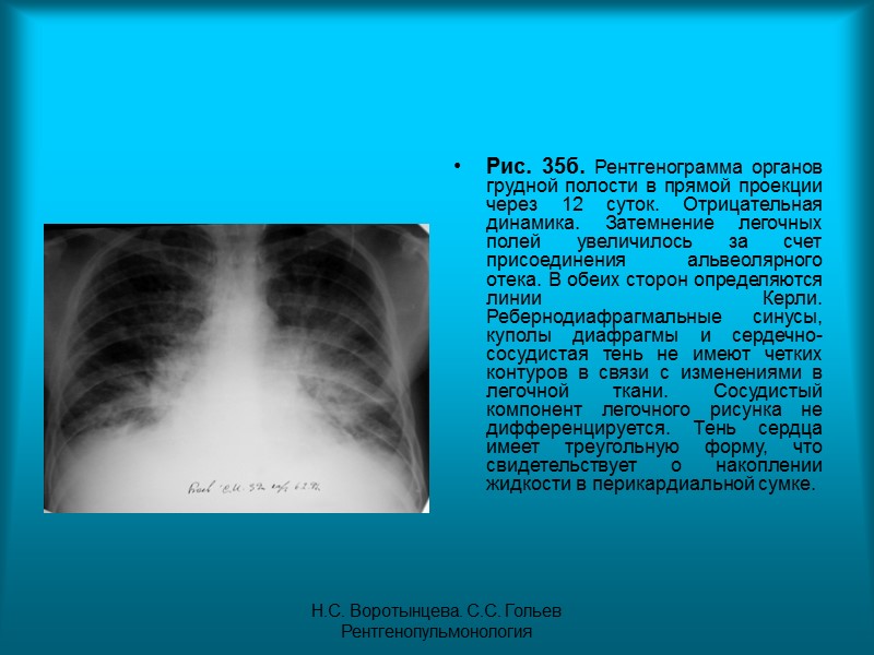 Н.С. Воротынцева. С.С. Гольев  Рентгенопульмонология Рис. 34г. Пациент Ф. 8 мес.  Диагноз: