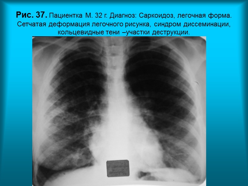 Н.С. Воротынцева. С.С. Гольев  Рентгенопульмонология Пациент Б. 39л. Диагноз: Инфаркт миокарда.  