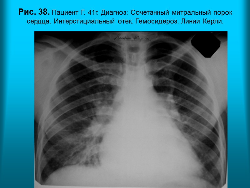 Н.С. Воротынцева. С.С. Гольев  Рентгенопульмонология Рис. 35б. Рентгенограмма органов грудной полости в прямой