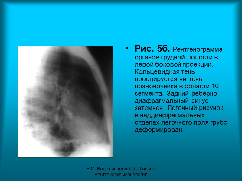Н.С. Воротынцева. С.С. Гольев  Рентгенопульмонология Пациентка Р. 43г. Диагноз: Периферический бронхиолоальвеолярный рак верхней