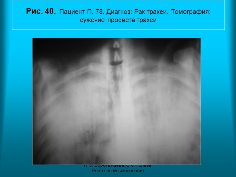 Н.С. Воротынцева. С.С. Гольев  Рентгенопульмонология Рис. 39а. Пациентка  М. 50л. . Диагноз: