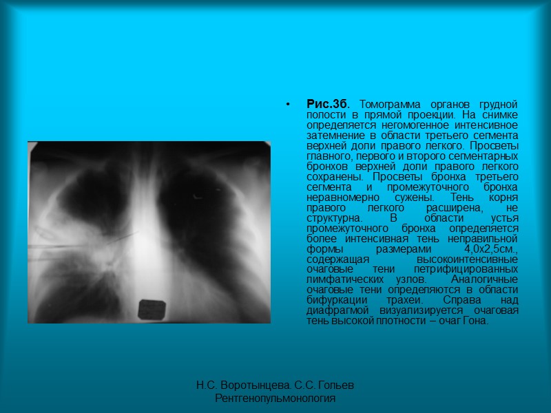Н.С. Воротынцева. С.С. Гольев  Рентгенопульмонология Рис. 40.  Пациент П. 78. Диагноз: Рак