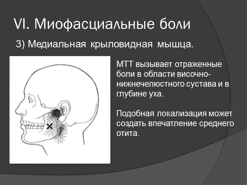 VI. Миофасциальные боли  1) Грудинноключично-сосцевидная мышца    МТТ латеральной головке 
