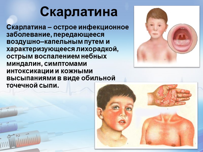 Профилактика скарлатины Так как вакцины от скарлатины не существует, основными средствами профилактики заболевания являются