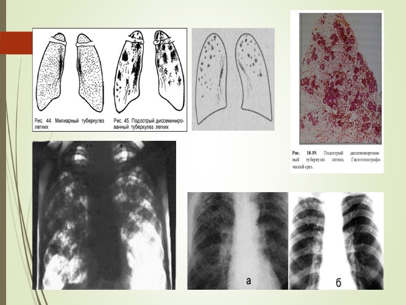Диссеминированный туберкулез — клиническая форма, которая объединяет специфические процессы в результате распространения МБТ в