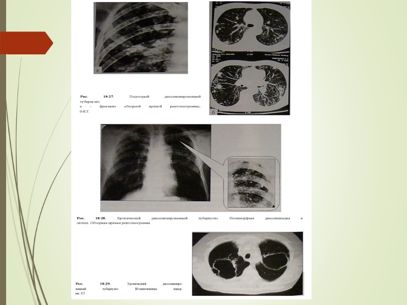 9. Рентгенологическая картина «снежной бури» характерна для: а) хронического диссеминированного туберкулеза б) инфильтративного туберкулёза