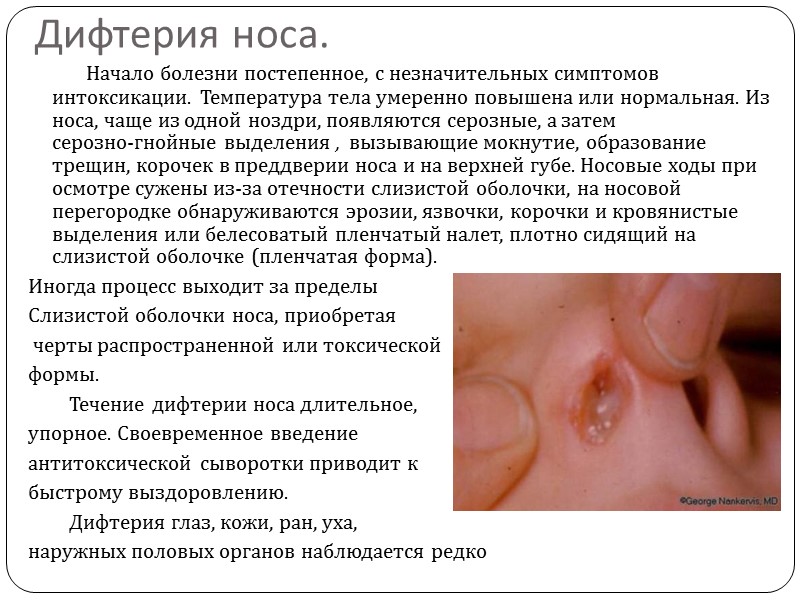 Понятие дифтерии.      Дифтерия (diphteria) – острое инфекционное заболевание, вызываемое