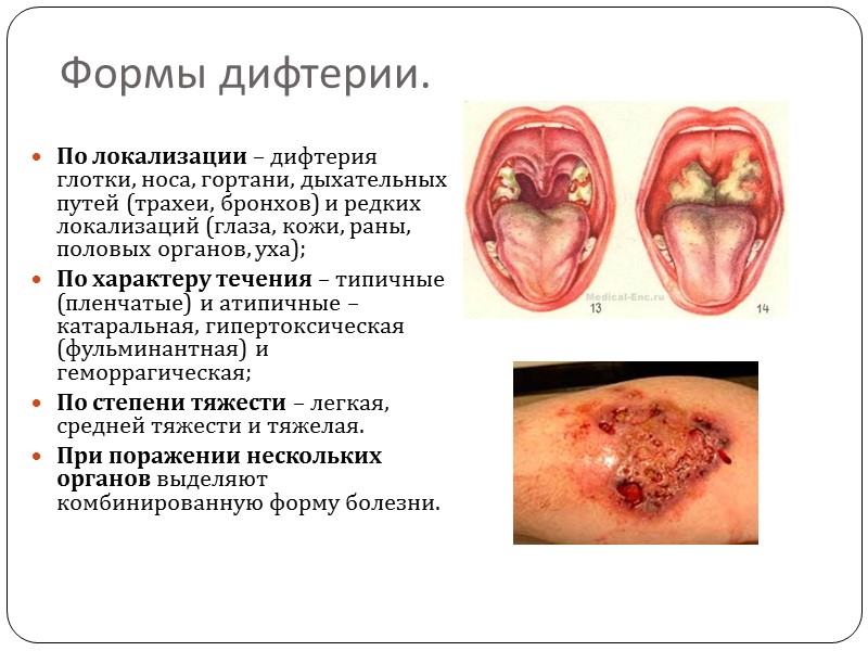Осложнения дефтерии. Выделяют специфические (токсические) и неспецифические осложнения дифтерии. Специфические осложнения.  Могут развиваться