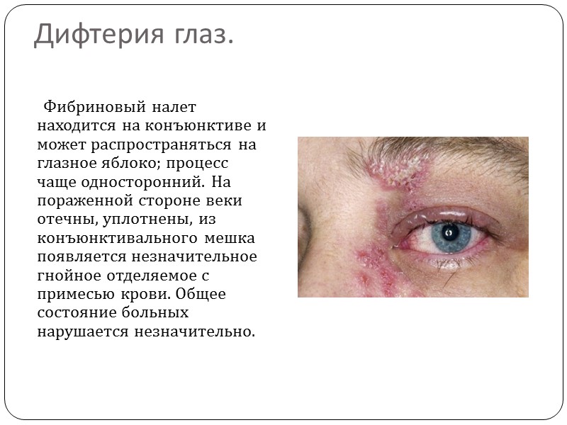 Исторические сведения.          Упоминания о дифтерии