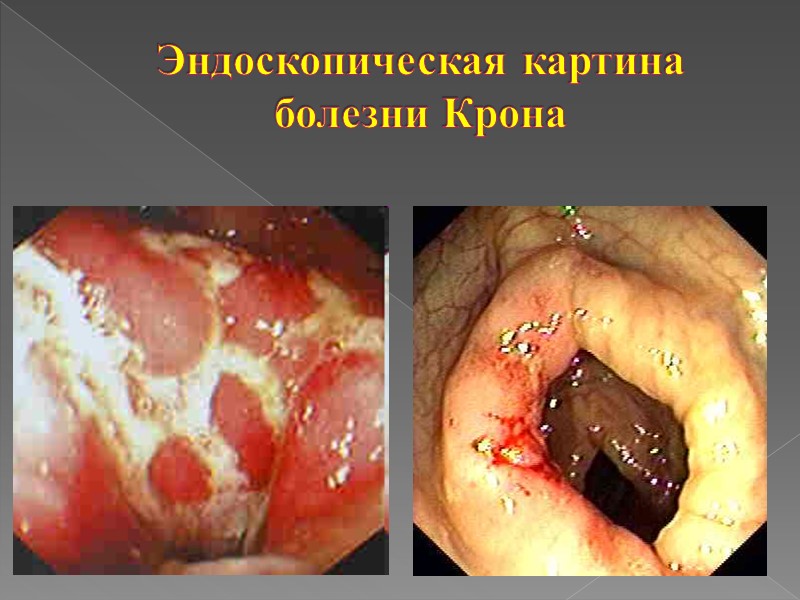 Диагностика ЯК При фиброколоноскопии отмечают: отек и гиперемия слизистой оболочки сигмовидной и прямой кишок;