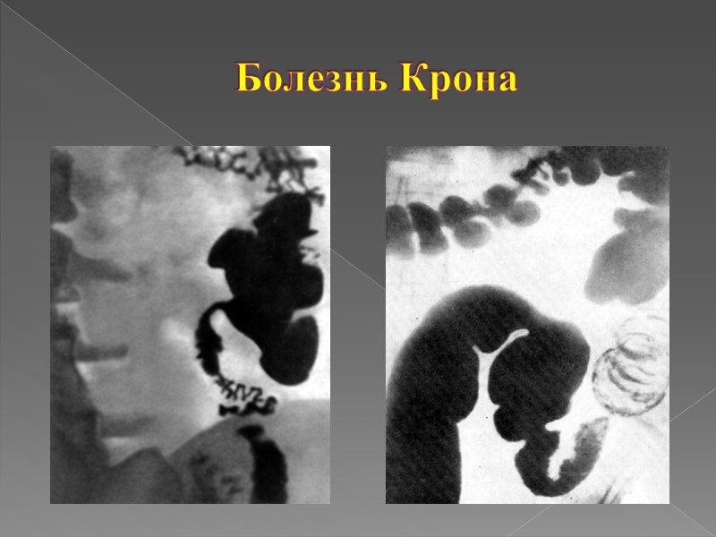 Клинические проявления Болезни Крона боль в животе, примесь крови и слизи в кале, 