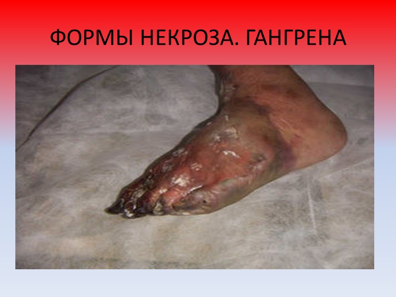 Локальное отсутствие меланина в виде разной формы очагов может наблюдаться после воспалительных заболеваний кожи