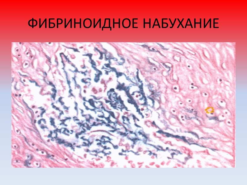 ГИАЛИНОВО-КАПЕЛЬНАЯ БЕЛКОВАЯ