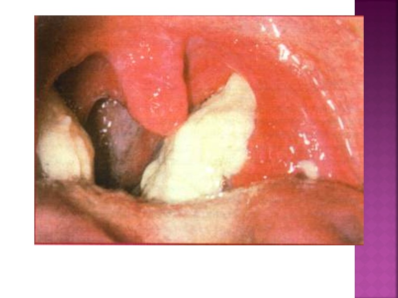 Патогенез В области многослойного плоского эпителия (носоглотка и ротоглотка) развивается дифтеритическое воспаление.  В