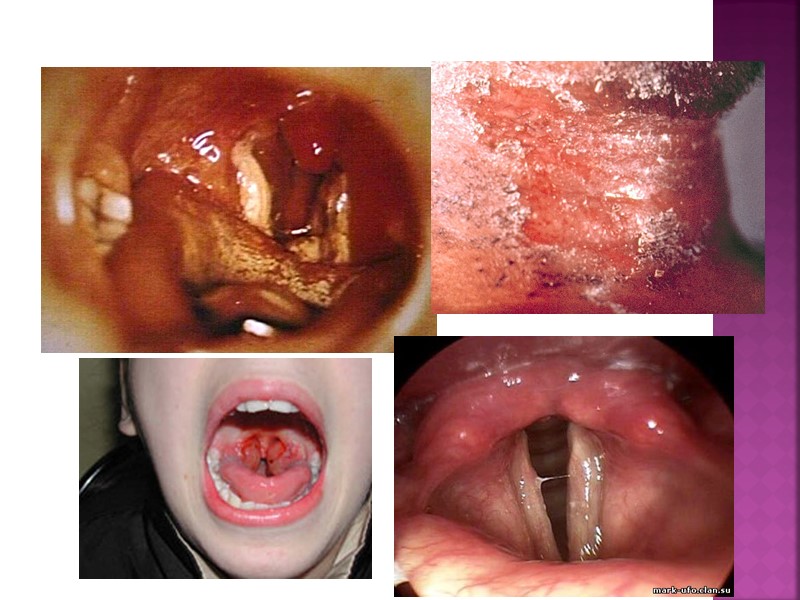 Дифтерия — опасное инфекционное заболевание, вызываемое бактерией Corynebacterium diphtheriae (палочка Леффлера). Инфекция передаётся воздушно-капельным