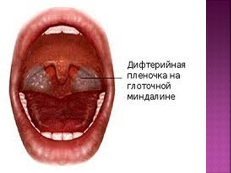 Лечение Проводится в стационаре Изоляция в боксе Взятие мазков из зева и носа для