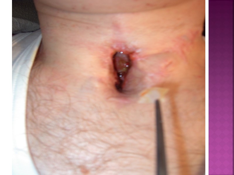 Осложнения Миокардиты, нарушения работы нервной системы, которые обычно проявляются в виде параличей. Чаще всего