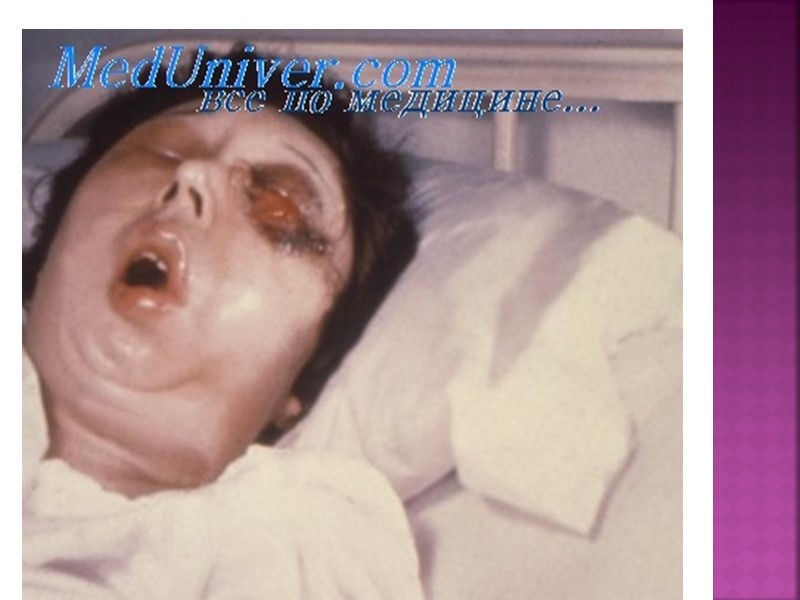 Иммунитет После перенесенного заболевания формируется нестойкий иммунитет, и приблизительно через 10-11 лет человек может