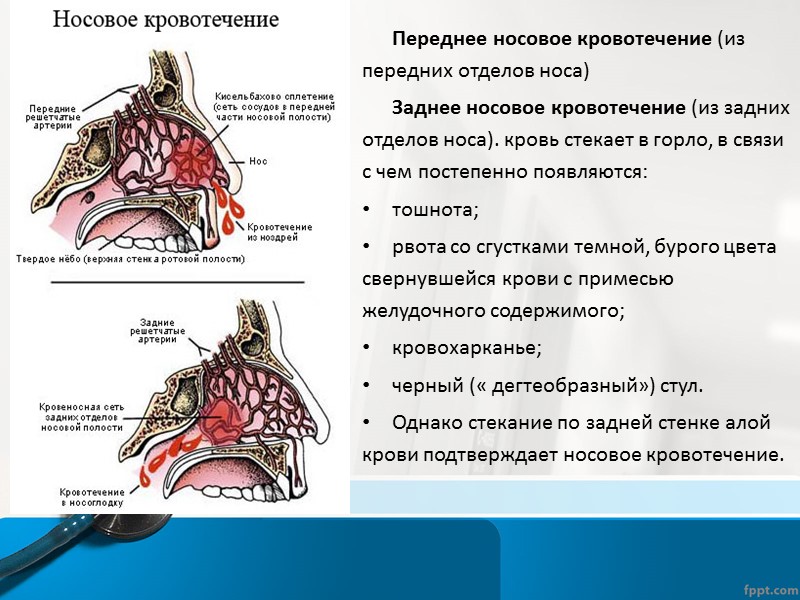 В редких случаях при травмах головы возникает сильное рецидивирующее «профузное» кровотечение из носа, обусловленное