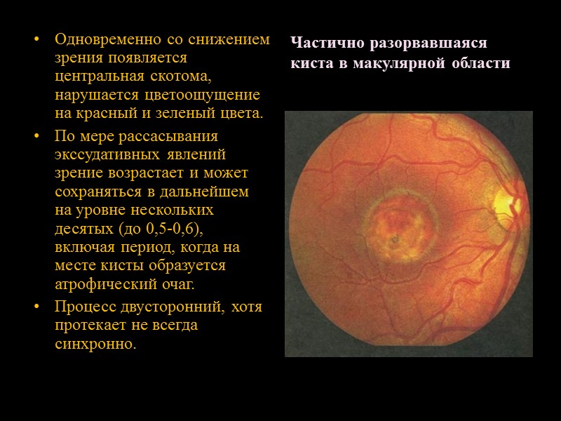 Вителлиформная стадия. Под сетчаткой, обычно на обоих глазах. имеется четко очерченный непроминирующий желтоватый очаг