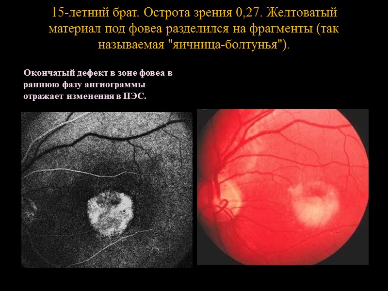 Одновременно со снижением зрения появляется центральная скотома, нарушается цветоощущение на красный и зеленый цвета.