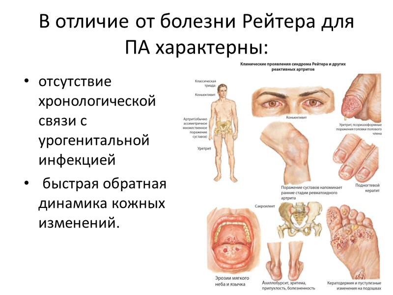 Новая кость сужение суставной щели эрозии Веретенообразная припухлость мягких тканей