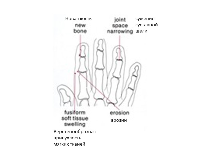 Диагностические критерии псориатического артрита (продолжение)  