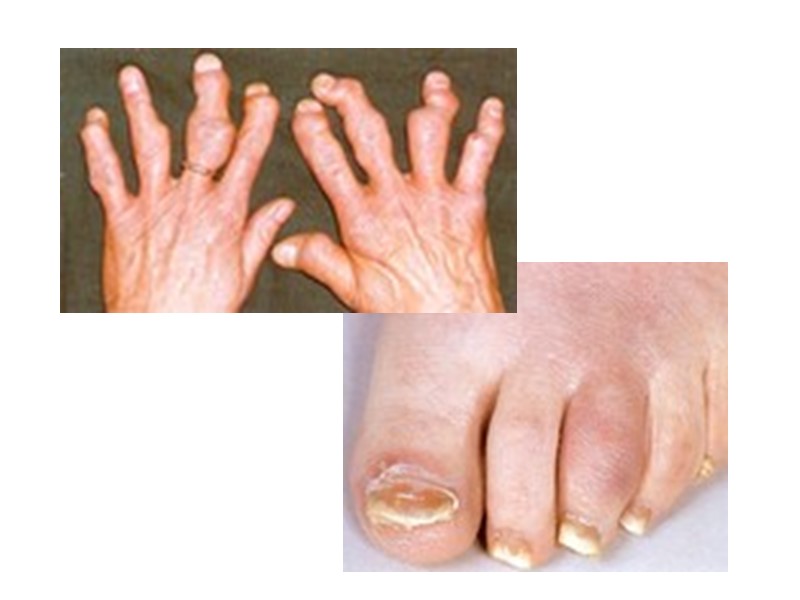 Подагрический артрит может быть предположен в случае остро развившегося артрита первого плюснефалангового сустава стопы,