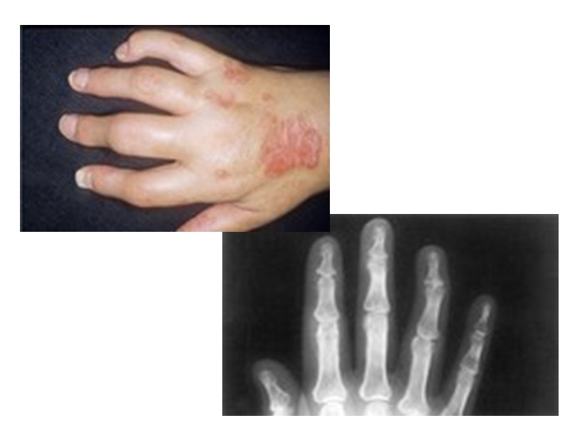 При SAPHO-синдроме  (S - sinovitis, синовит; А - acne, акне; Р - pustulosis,