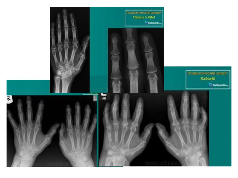 Критерии исключения псориатического артрита  отсутствие псориаза -5 серопозитивность по ревматоидному фактору -5 ревматоидные