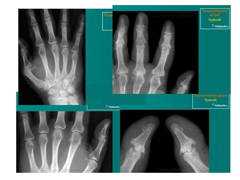 При сумме баллов 16 - псориатический артрит классический;  11 - 15 - псориатический