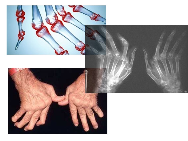 Рентгенологические признаки, помогающие отличить псориатический артрит от других воспалительных ревматических заболеваний суставов: Асимметричность поражения