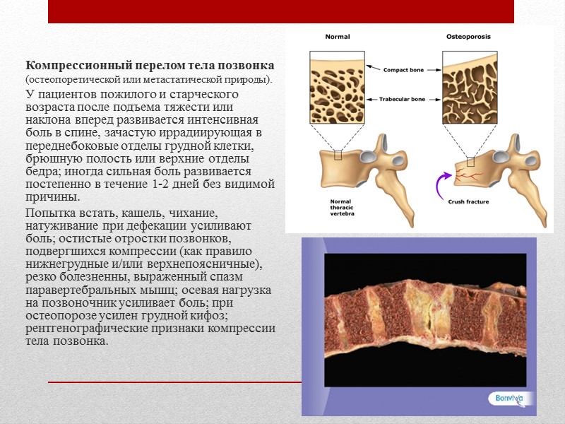 Люмбальный стеноз Это сужение спинномозгового канала, которое приводит к ишемии нервных корешков и способствует