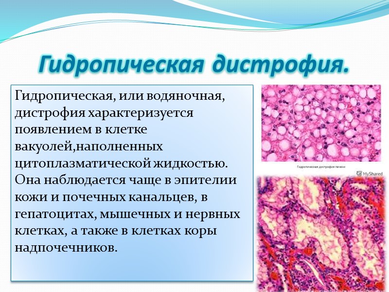 Дистрофия - сложный патологический процесс, в основе которого лежит нарушение тканевого (клеточного) метаболизма, ведущее