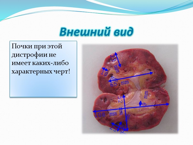 Роговая дистрофия Роговая дистрофия, или патологическое ороговение, характеризуется избыточным образованием рогового вещества в ороговевающем