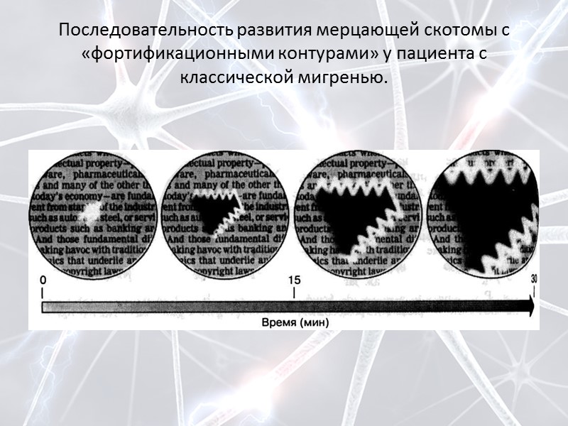 Мерцание в глазах. Мигрень Зрительная Аура скотома. Мерцательная скотома. Мерцающая скотома. Мерцательная Зрительная скотома.