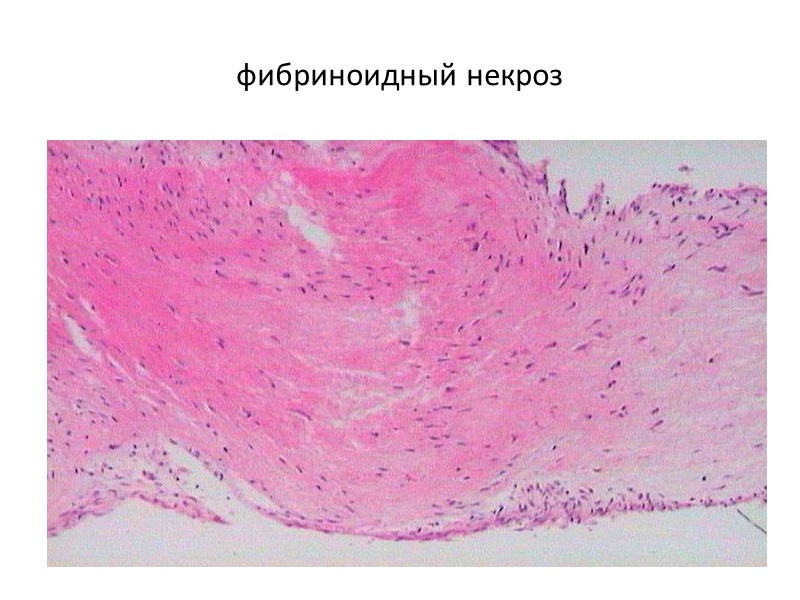 Макро: при гемосидерозе органы имеют буро-ржавый цвет.  Микро: выявляется при постановке реакции Перлса