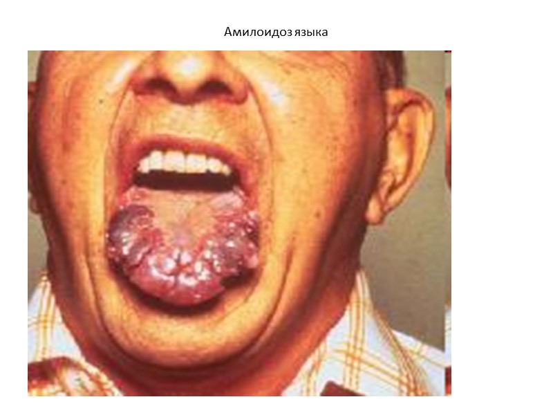 Гипермеланозы  Общий врожденный: пигментная ксеродерма. Редкое заболевание, при котором резко снижена или отсутствует