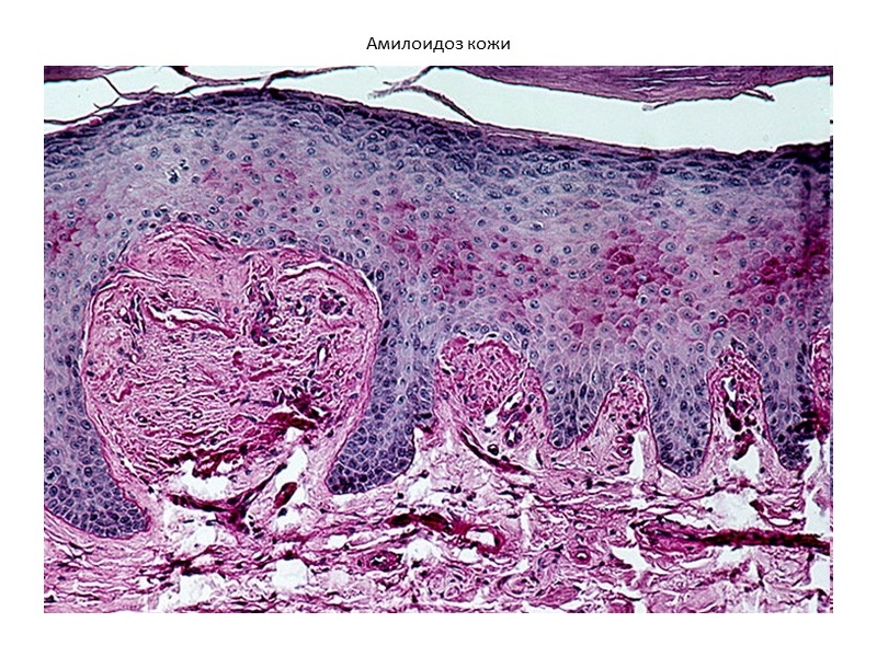 Гипермеланозы Местный врожденный гипермеланоз меланоз Дюбрея (образования, на коже туловища и лица, неравномерно окрашены