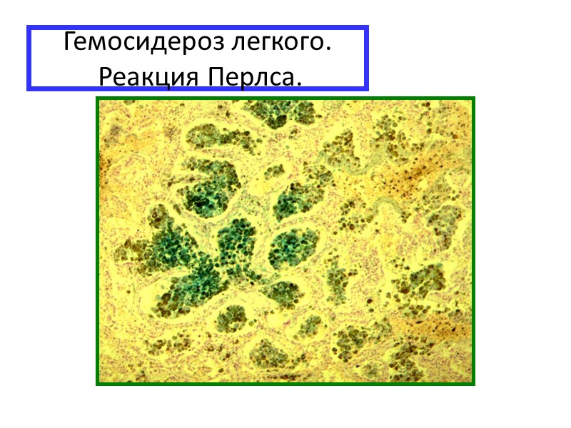 Слева – миокард в норме, справа – в состоянии клеточной жировой дистрофии, окраска суданом